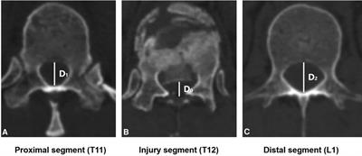 Posterior unilateral approach with 270° spinal canal decompression and three-column reconstruction using double titanium mesh cage for thoracic and lumbar burst fractures